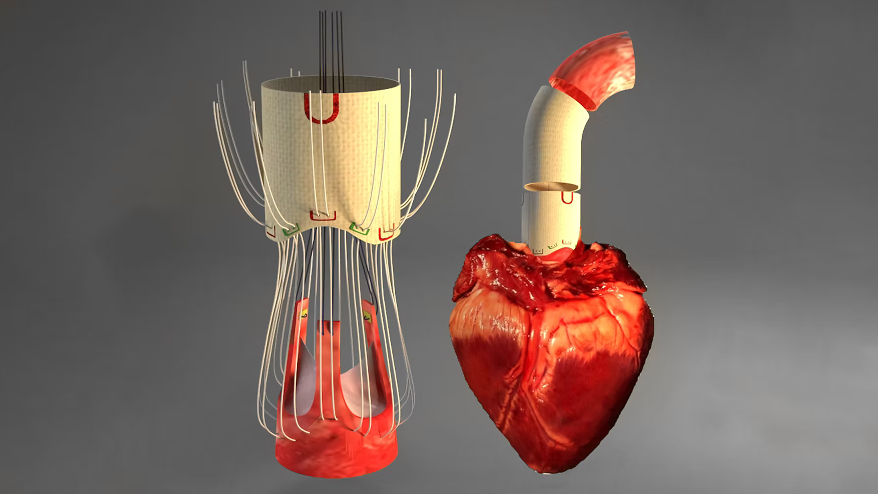 EDF device: surgical application